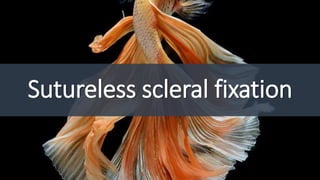 Sutureless scleral fixation
 