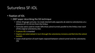 Sutureless SF-IOL
• fixation of IOL
• 2007 paper describing the SIS technique
• Utilize 24-gauge cannulas to create diametrically opposite ab externo sclerotomies at a
distance of 1.5-2.0 mm from the limbus
• Cannulas were used to create 50% thick scleral tunnels parallel to the limbus near each
of the original sclerotomy sites
• 3-pieces IOL is inserted
• Haptics are externalized in turn through the sclerotomy incisions and fed into the scleral
tunnels
• Leave small portion of each haptic exposed between scleral tunnel and the sclerotomy
site
 