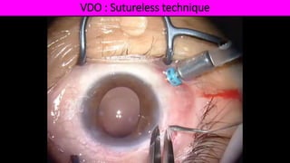 VDO : Sutureless technique
 