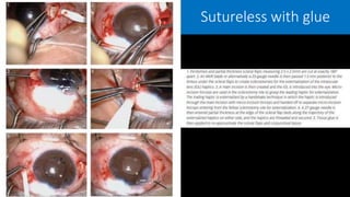 Sutureless with glue
 