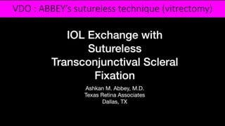 VDO : ABBEY’s sutureless technique (vitrectomy)
 