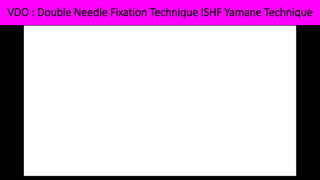VDO : Double Needle Fixation Technique ISHF Yamane Technique
 