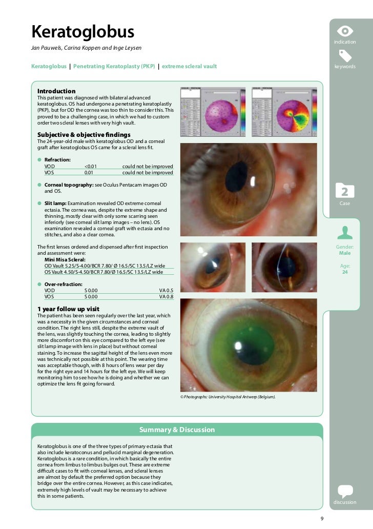 clinical try of beyond contact lenses clinical try of beyond contact lenses