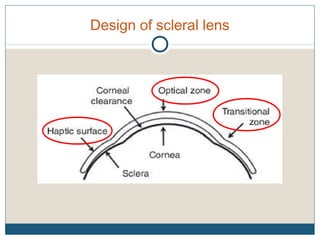 Design of scleral lens
 