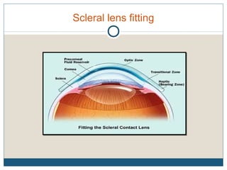 Scleral lens fitting
 