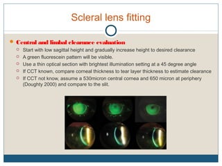Scleral lens fitting
 Central and limbal clearance evaluation
 Start with low sagittal height and gradually increase height to desired clearance
 A green fluorescein pattern will be visible.
 Use a thin optical section with brightest illumination setting at a 45 degree angle
 If CCT known, compare corneal thickness to tear layer thickness to estimate clearance
 If CCT not know, assume a 530micron central cornea and 650 micron at periphery
(Doughty 2000) and compare to the slit.
 