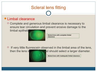 Scleral lens fitting
Limbal clearance
 Complete and generous limbal clearance is necessary to
ensure tear circulation and prevent erosive damage to the
limbal epithelial cells.
 If very little fluorescein observed in the limbal area of the lens,
then the lens is too small and should select a larger diameter.
Scleral lens with inadequate limbal clearance
Scleral lens with complete limbal
clearance
 