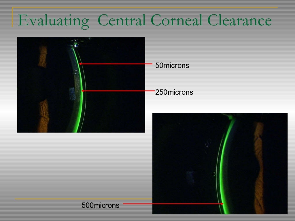 Scleral lenses presentation final (1)
