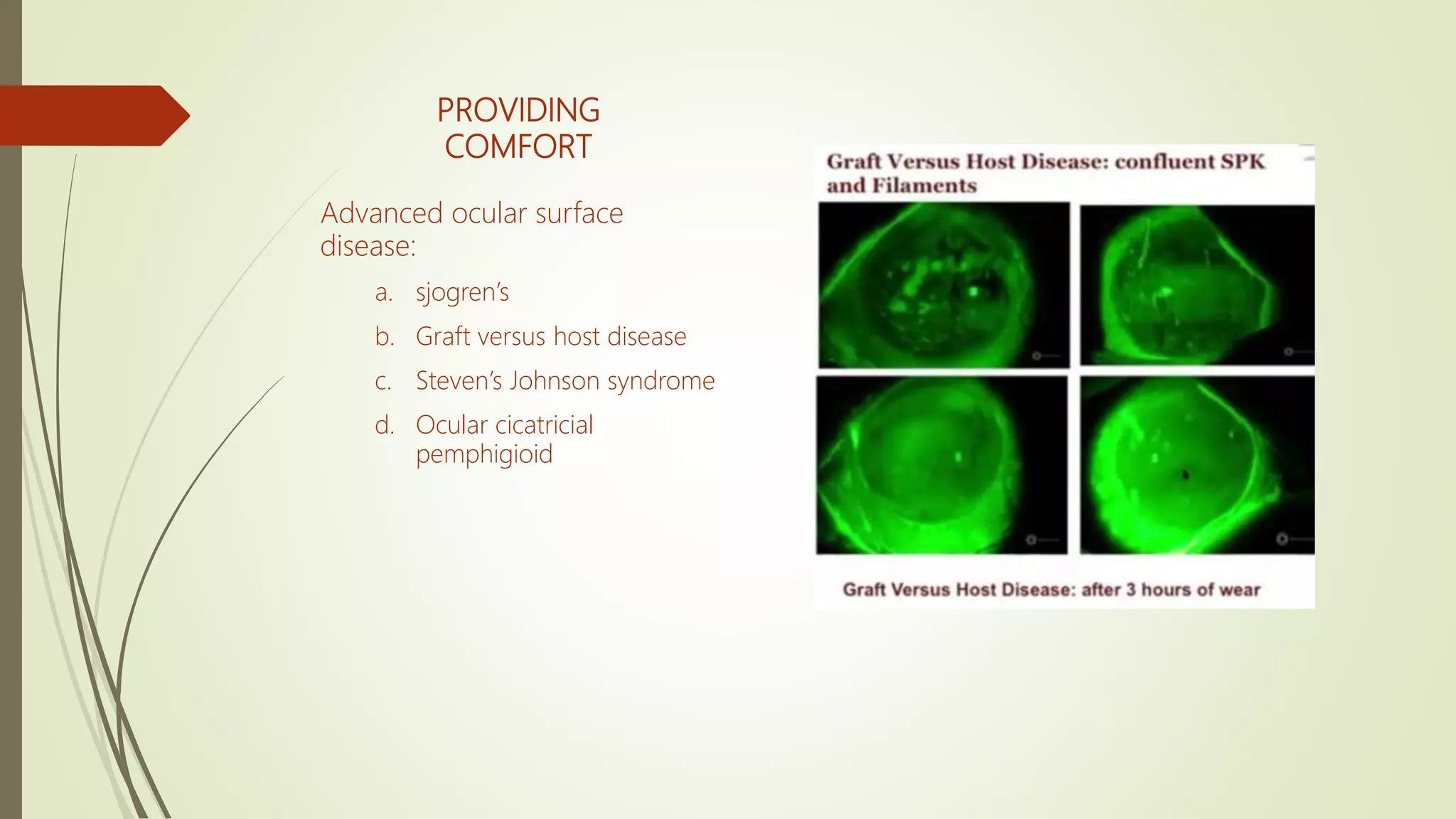 PROVIDING
COMFORT
Advanced ocular surface
disease:
a. sjogren’s
b. Graft versus host disease
c. Steven’s Johnson syndrome
d. Ocular cicatricial
pemphigioid
 