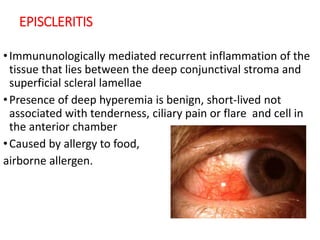 EPISCLERITIS
•Immununologically mediated recurrent inflammation of the
tissue that lies between the deep conjunctival stroma and
superficial scleral lamellae
•Presence of deep hyperemia is benign, short-lived not
associated with tenderness, ciliary pain or flare and cell in
the anterior chamber
•Caused by allergy to food,
airborne allergen.
 