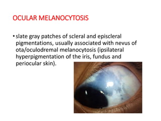 OCULAR MELANOCYTOSIS
•slate gray patches of scleral and episcleral
pigmentations, usually associated with nevus of
ota/oculodremal melanocytosis (ipsilateral
hyperpigmentation of the iris, fundus and
periocular skin).
 