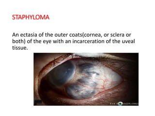 STAPHYLOMA
An ectasia of the outer coats(cornea, or sclera or
both) of the eye with an incarceration of the uveal
tissue.
 