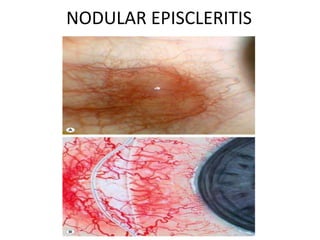 NODULAR EPISCLERITIS
 
