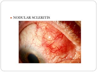 Scleritis Racgp SCLERITIS- various presentations ,investigations and treatment ...
