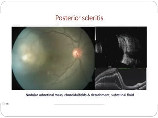 Scleritis Racgp SCLERITIS- various presentations ,investigations and treatment ...