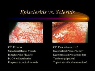 Scleritis Racgp SCLERITIS- various presentations ,investigations and treatment ...