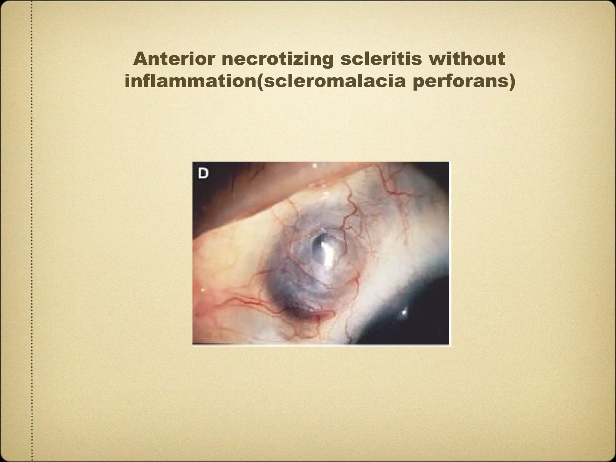Anterior necrotizing scleritis without
inflammation(scleromalacia perforans)
 