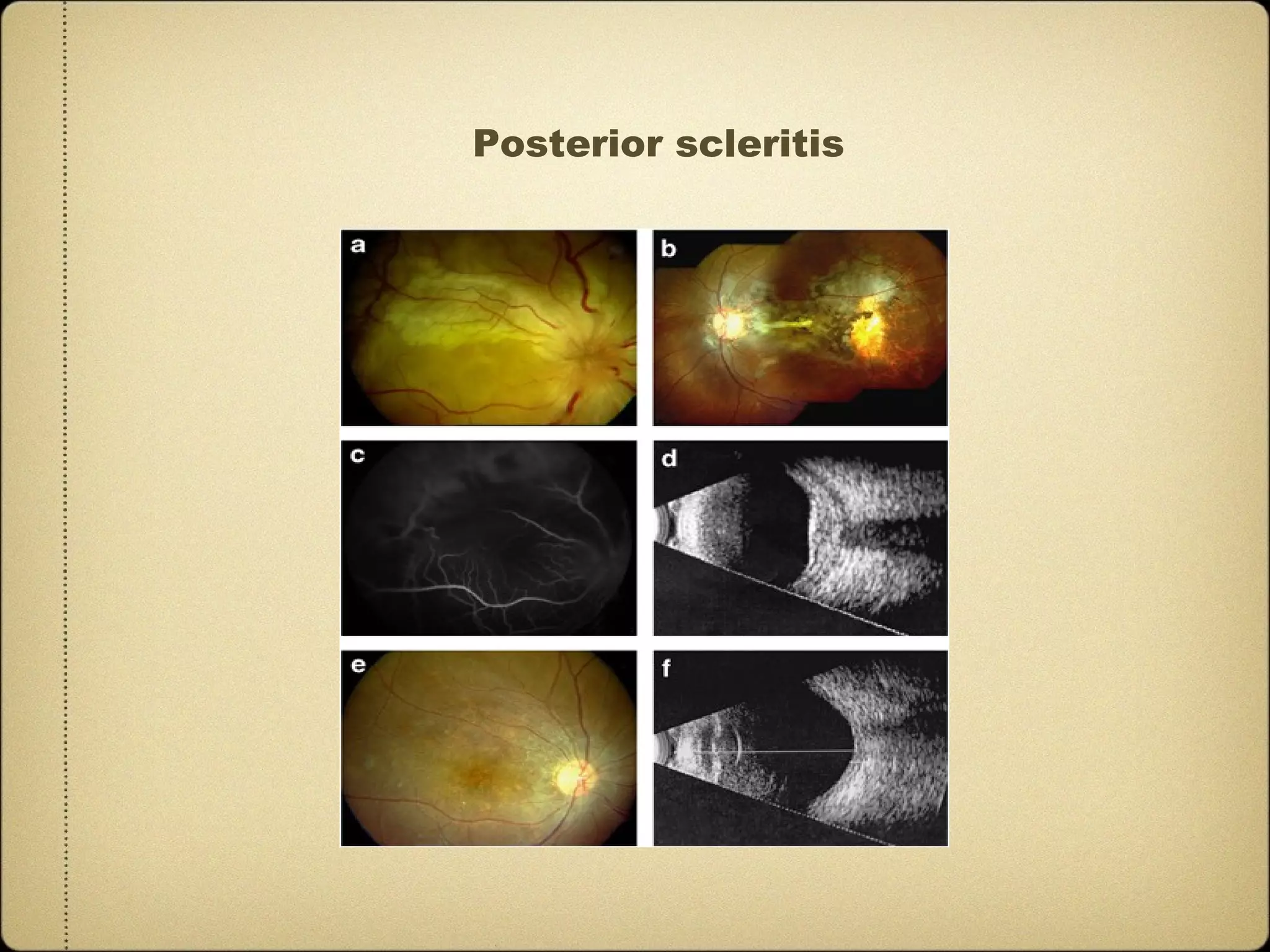 Posterior scleritis
 
