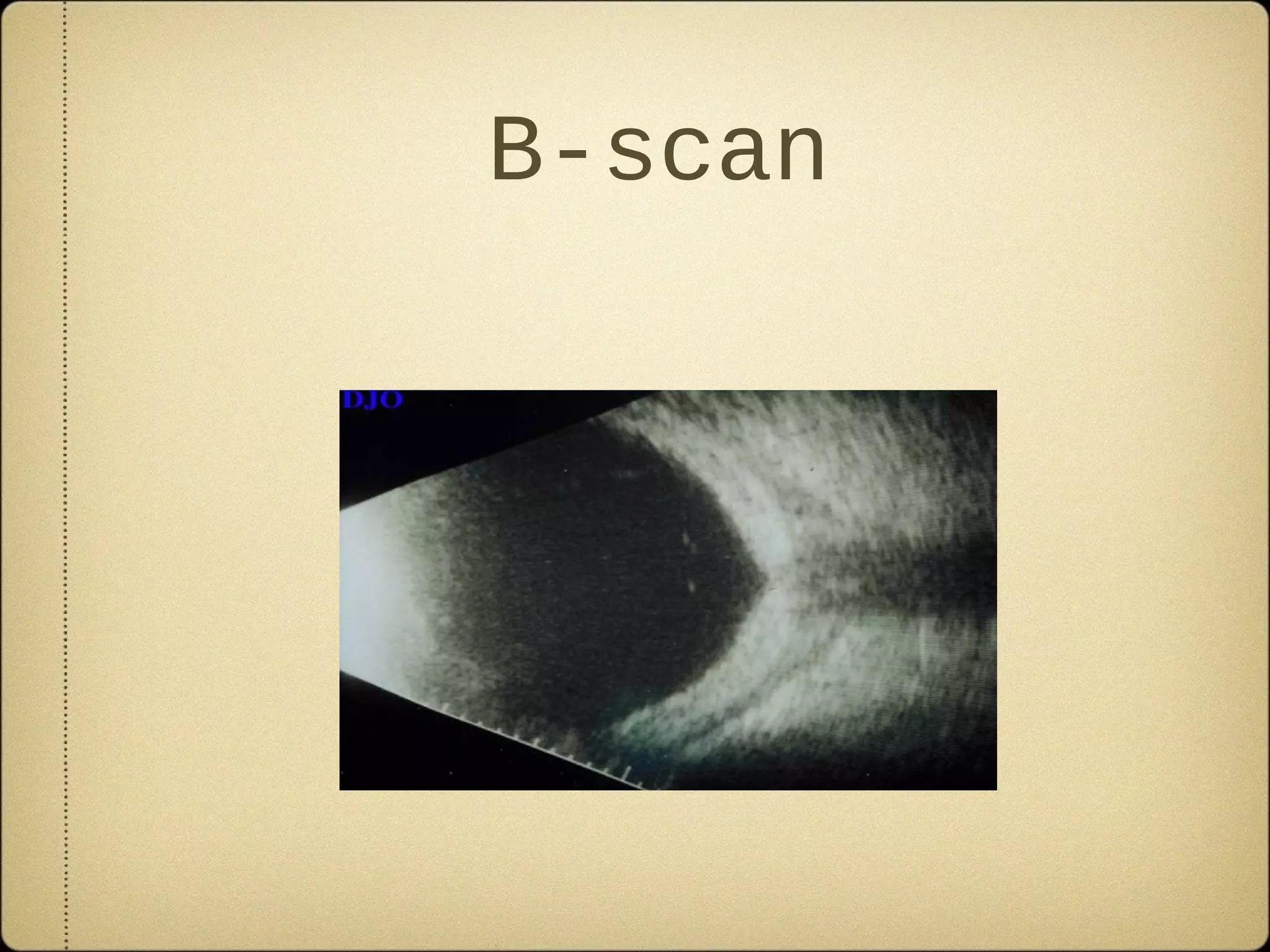 B-scan
 