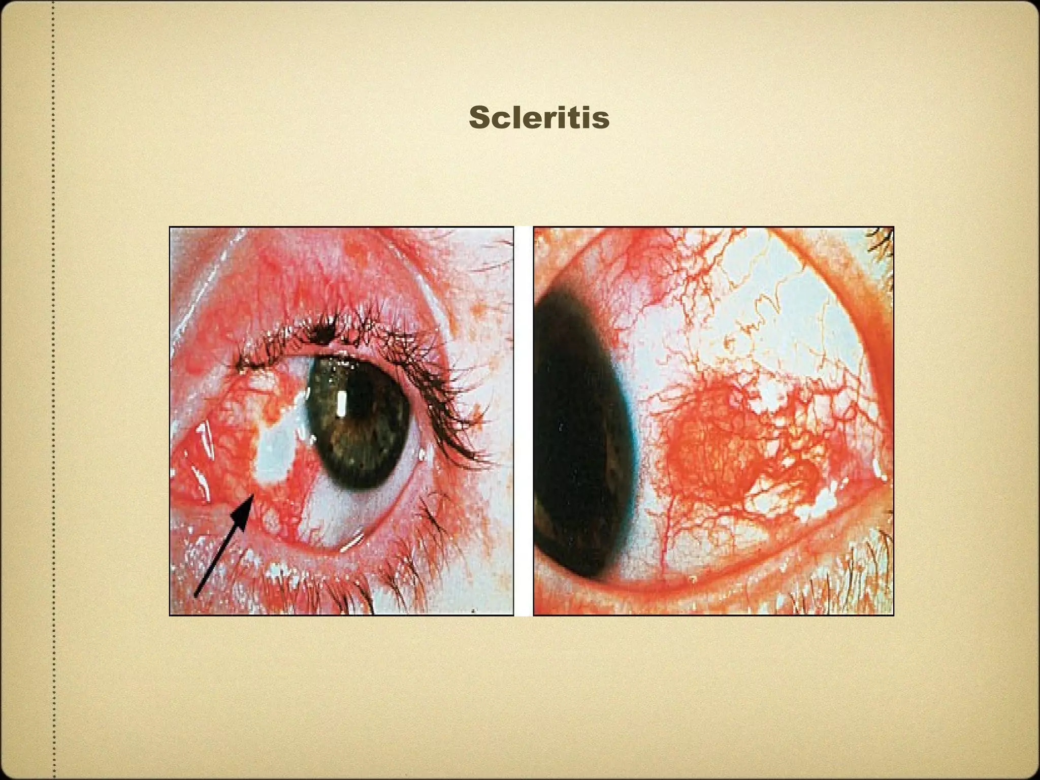 Scleritis
 