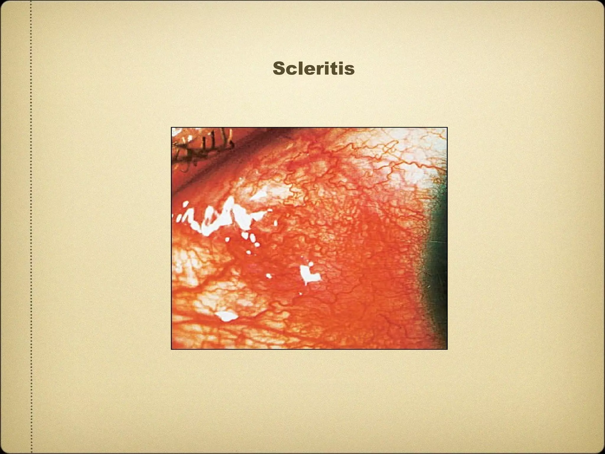 Scleritis
 