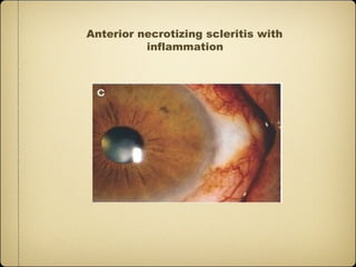 Anterior necrotizing scleritis with
          inflammation
 