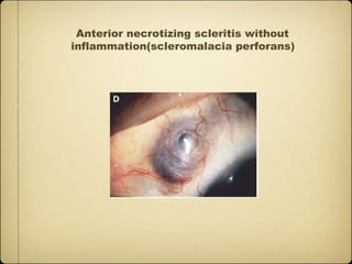 Anterior necrotizing scleritis without
inflammation(scleromalacia perforans)
 