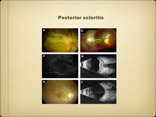 Posterior scleritis
 