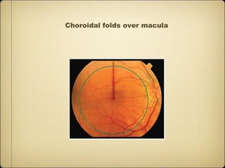 Choroidal folds over macula
 
