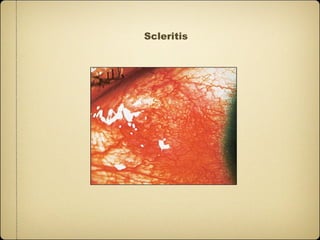 Scleritis
 