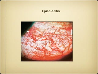 Episcleritis
 