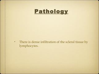 Pathology




•   There is dense infiltration of the scleral tissue by
    lymphocytes.
 