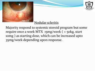 Nodular scleritis
Majority respond to systemic steroid program but some
require once a week MTX 15mg/week ( < 50kg, start
10mg ) as starting dose, which can be increased upto
35mg/week depending upon response.
 
