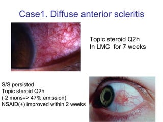 Topic steroid Q2h In LMC  for 7 weeks S/S persisted  Topic steroid Q2h ( 2 mons=> 47% emission) NSAID(+) improved within 2 weeks Case1. Diffuse anterior scleritis  