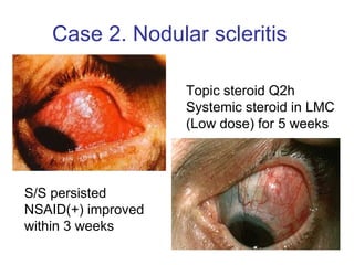 Topic steroid Q2h  Systemic steroid in LMC (Low dose) for 5 weeks S/S persisted  NSAID(+) improved within 3 weeks Case 2. Nodular scleritis  