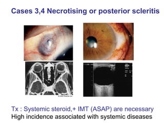Cases 3,4 Necrotising or posterior scleritis   Tx : Systemic steroid,+ IMT (ASAP) are necessary High incidence associated with systemic diseases 