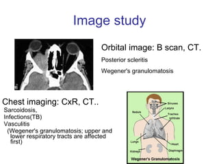 Image study Chest imaging: CxR, CT..  Sarcoidosis,  Infections(TB)  Vasculitis  (Wegener's granulomatosis; upper and lower respiratory tracts are affected first)  Orbital image: B scan, CT. Posterior scleritis  Wegener's granulomatosis 