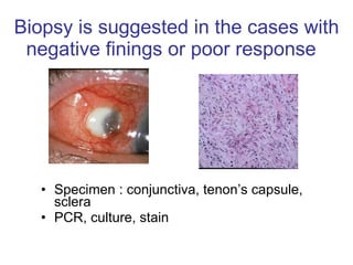 Biopsy is suggested in the cases with negative finings or poor response  Specimen : conjunctiva, tenon’s capsule, sclera PCR, culture, stain 