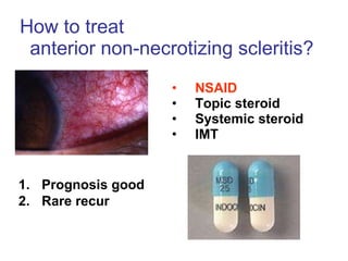How to treat  anterior non-necrotizing scleritis?  NSAID Topic steroid  Systemic steroid IMT Prognosis good Rare recur 