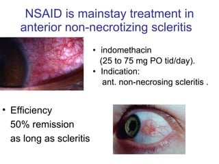 NSAID is mainstay treatment in anterior non-necrotizing scleritis  indomethacin  (25 to 75 mg PO tid/day). Indication:  ant. non-necrosing scleritis .  Efficiency 50% remission as long as scleritis 