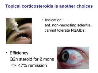 Topical corticosteroids is another choices Indication:  ant. non-necrosing scleritis .  cannot tolerate NSAIDs. Efficiency Q2h steroid for 2 mons =>  47% remission 