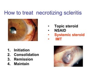 How to treat  necrotizing scleritis  Topic steroid NSAID  Systemic steroid  IMT   Initiation  Consolidation Remission Maintain 