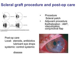 Scleral graft procedure and post-op care  Procedure Scleral patch Adjuvant procedure Epithelization : AMT, vasculization conjunctival flap Post-op care  Local:  steroids, antibiotics lubricant eye drops systemic: control systemic  disease  