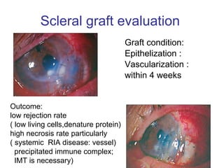 Scleral graft evaluation  Graft condition:  Epithelization : Vascularization :  within 4 weeks Outcome:  low rejection rate  ( low living cells,denature protein) high necrosis rate particularly  ( systemic  RIA disease: vessel) precipitated immune complex;  IMT is necessary) 