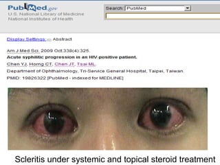 Scleritis under systemic and topical steroid treatment  