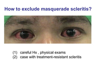 How to exclude masquerade scleritis? careful Hx , physical exams  case with treatment-resistant scleritis 