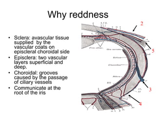 Sclera: avascular tissue supplied  by the vascular coats on episcleral choroidal side Episclera: two vascular layers superficial and deep. Choroidal: grooves caused by the passage of ciliary vessels Communicate at the root of the iris Why reddness 4 3 5 2 