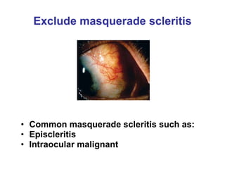 Exclude masquerade scleritis Common masquerade scleritis such as: Episcleritis  Intraocular malignant 