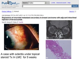 A case with scleritis under topical steroid Tx In LMC  for 5 weeks 