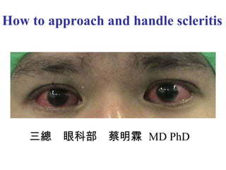 How to approach and handle scleritis  三總　眼科部　蔡明霖  MD PhD 
